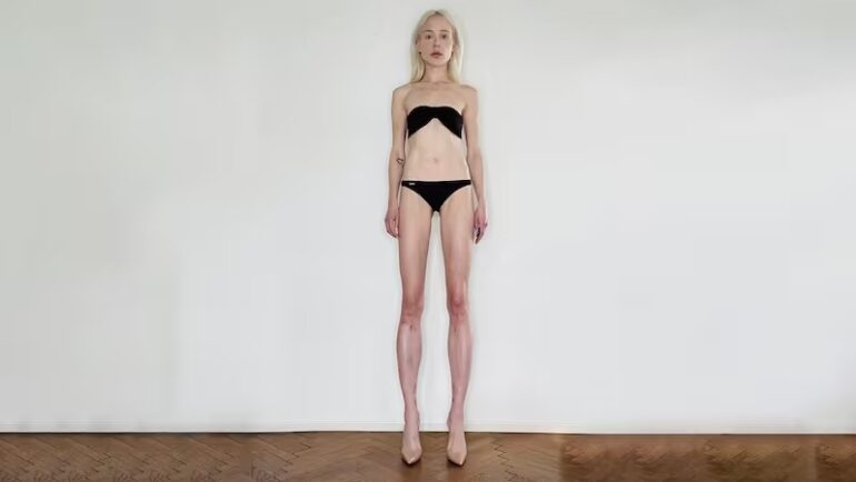 Theresia Fischer cao thêm 14 cm sau hai ca phẫu thuật kéo dài chân hồi đầu năm 2022. Ảnh: New York Post