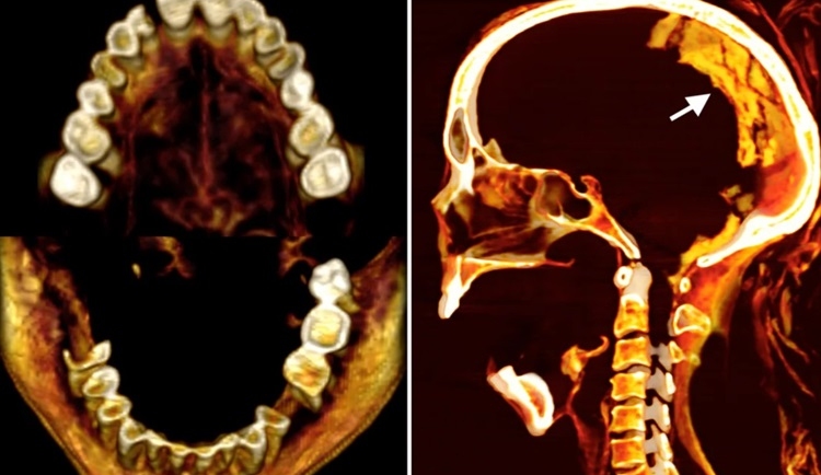 Ảnh chụp cắt cắt lớp khuôn miệng há to của Người phụ nữ hét. Ảnh: Sahar Saleem