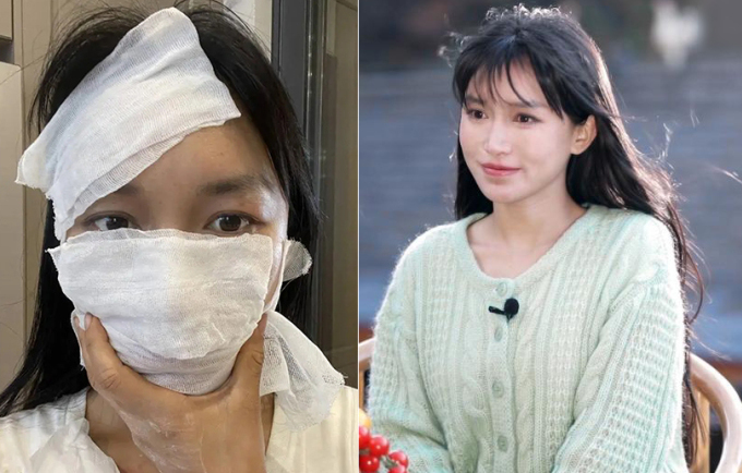 Tử Thất bị dị ứng khi làm đồ sơn mài năm 2023 và ở buổi phỏng vấn sau khi tái xuất. Ảnh: Xinhua