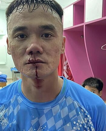 CLB PVF-CAND đăng ảnh tiền đạo Nguyễn Xuân Nam chảy máu mũi sau vụ đánh nhau với cầu thủ Trẻ TP HCM. Ảnh: Facebook/CLB Bóng đá PVF-CAND